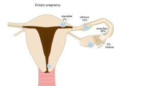 Ectopic pregnancy – es